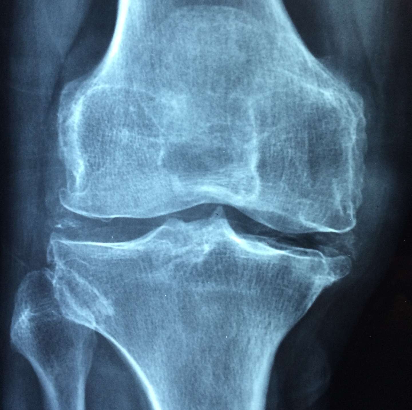 Knee osteoarthritis treatment physiotherapy Australia