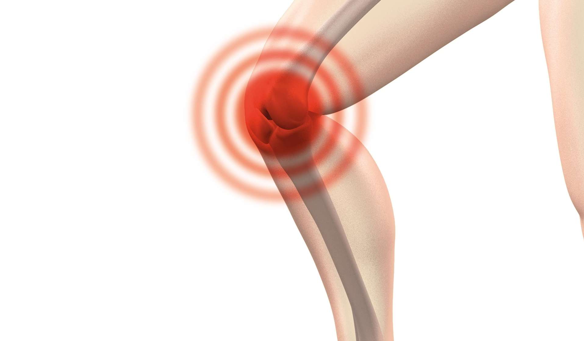 patellofemoral pain knee cap physiotherapy newcastle nsw