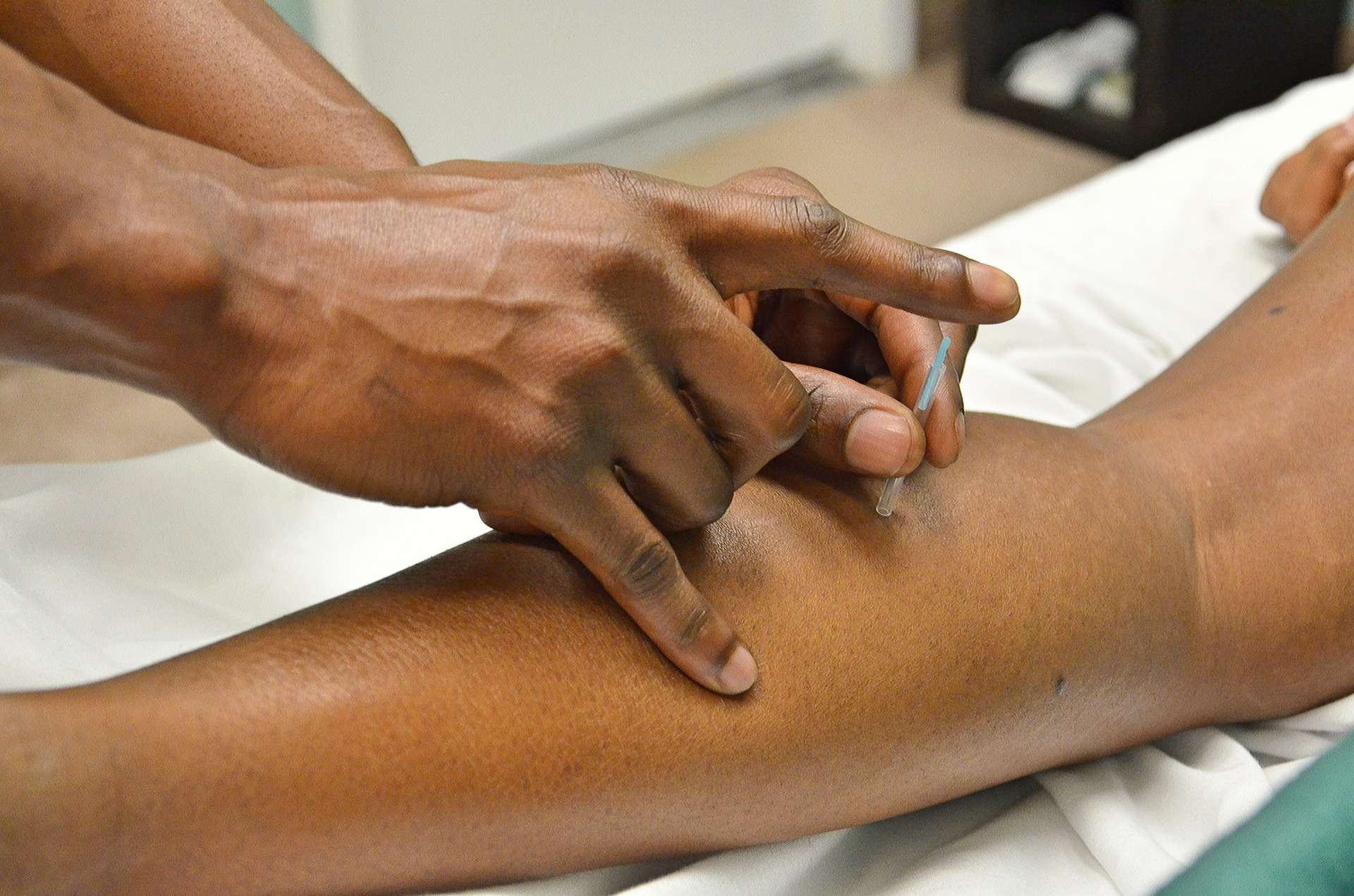 acupuncture trigger point dry needling