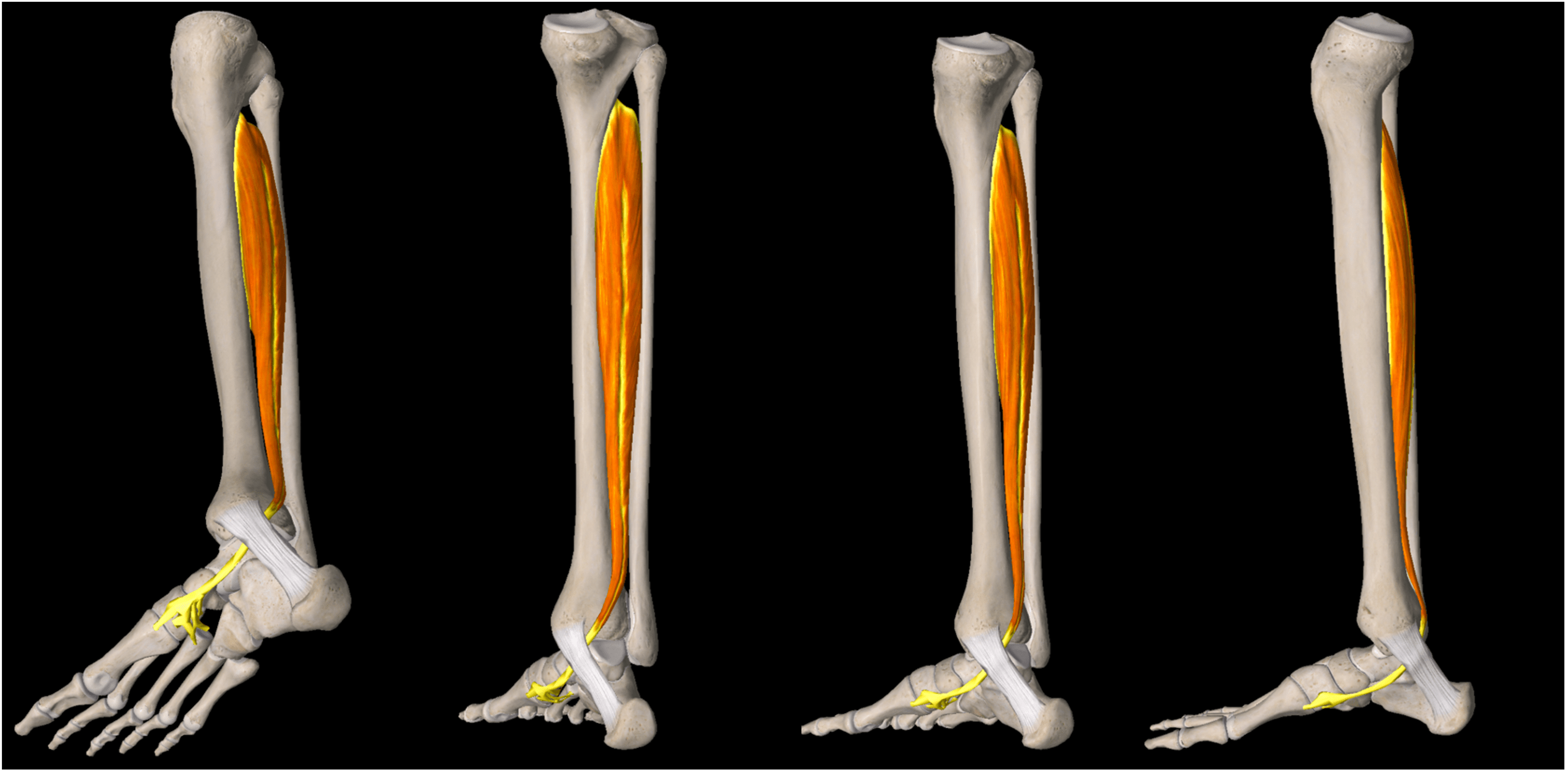 Posterior tibial tendonitis heel pain on sale